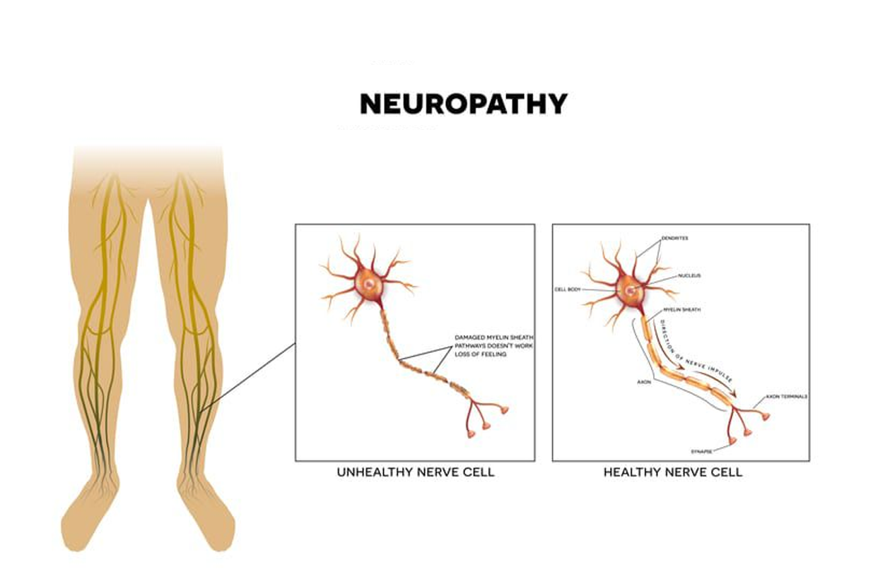 Neuropathy