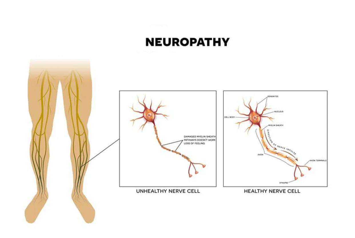 Neuropathy