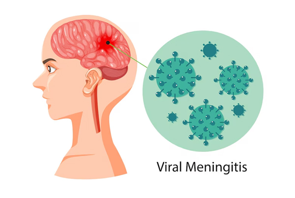 Meningitis