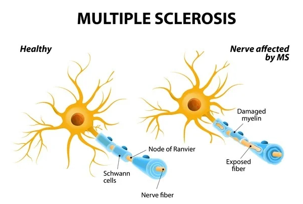 Multiple Sclerosis